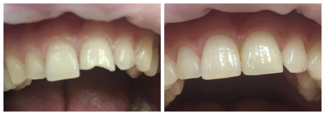 Результат протезирования передних зубов